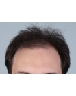 Before Hair Transplant &nbsp;Front